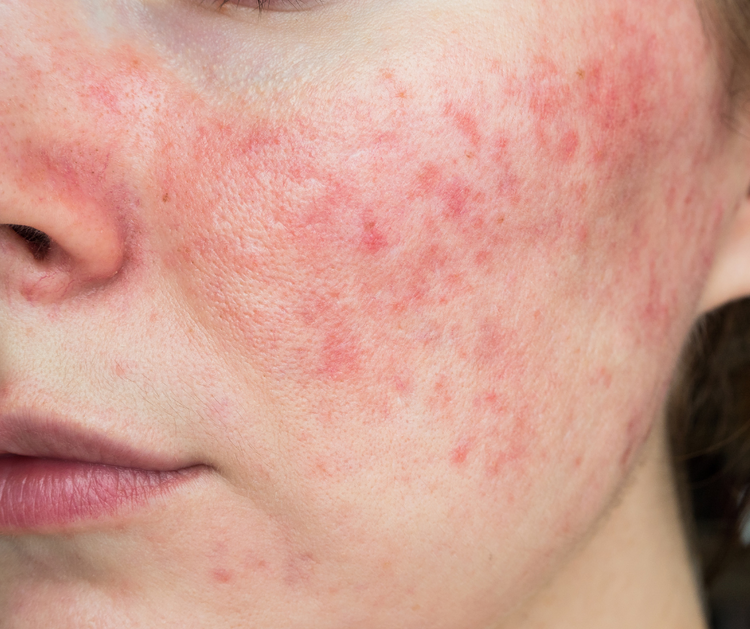 ROSACEA