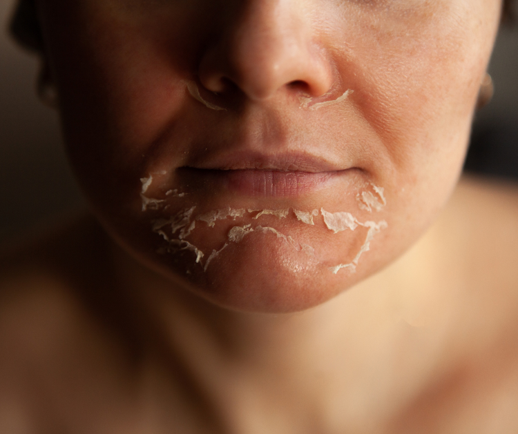 Peeling